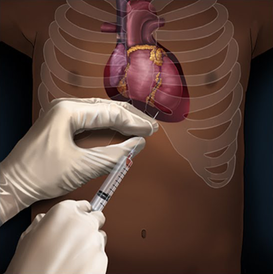 Procedimentos em Neonatologia – Módulo Pericardiocentese