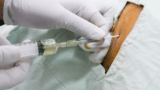 Procedimentos em Neonatologia - Módulo Paracentese Neonatal
